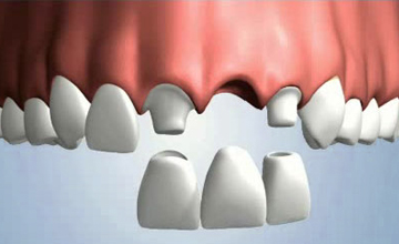 Navasota Dental bridge service