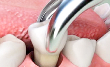 Navasota Dental Tooth Extractions service