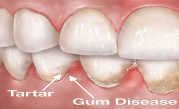 Navasota Dental Periodontal (Gum) Disease service