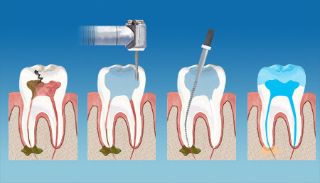 Navasota Dental Endodontics Therapy service